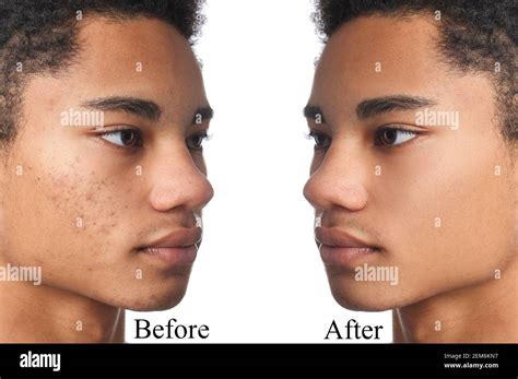 African American Teenage Boy Before And After Acne Treatment On White