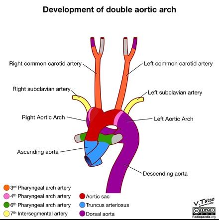 Variant Anatomy Of The Aortic Arch Radiology Reference Article