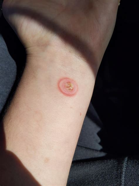 Infected It Was A 2nd Degree Burn From A Lighter And Blister Popped