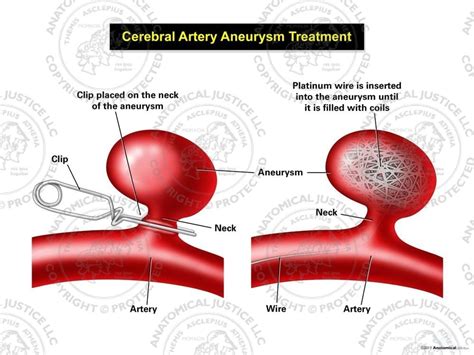 √ Aneurysm Endovascular Treatment Of Intracranial Aneurysms Because