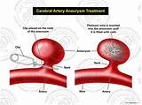 Thus far, we have been discussing about aneurysm in the aorta, the main blood vessel carrying blood from the heart to other parts of the body, owing to an. Cerebral Artery Aneurysm Treatment