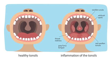 Sore Throat Tonsillitis Overview Causes Symptoms Treatment