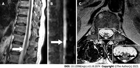 Spontaneous Conus Infarction With Snake Eye Appearance On Magnetic Resonance Imaging A Case