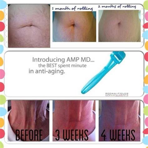 Stretch Marks Or Sagging Neck Skin Try Amp Md System Look At These Results These Results