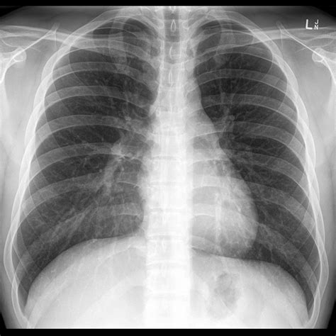 chest xray normal | Normal chest x-rays | Image | Radiopaedia.org | X ...