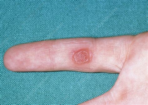 Large Common Wart On The Finger Stock Image M2900073 Science