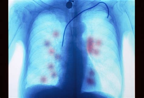 Metastatic Cancer To The Lungs Symptoms And Treatment