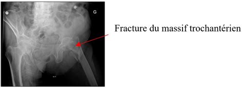 Fracture Du Massif Trochantérien Clou Gamma Chirurgie Orthopédique