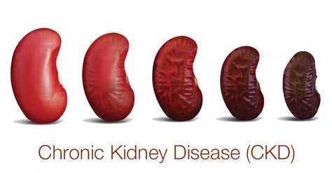 Stages Of Chronic Kidney Disease
