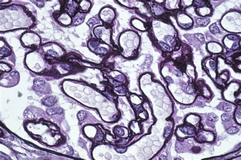 Kidney cancer is one of the top 10 most commonly diagnosed in the u.s. Looking at Survival Differently in Patients With ...