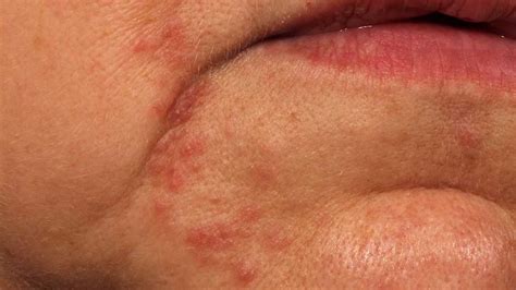 Flaky Skin On Face Around Mouth Red Rash Around Your Mouth Could Be