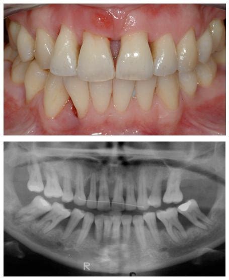 Bone Loss In Teeth Treatment Advanced Dentistry