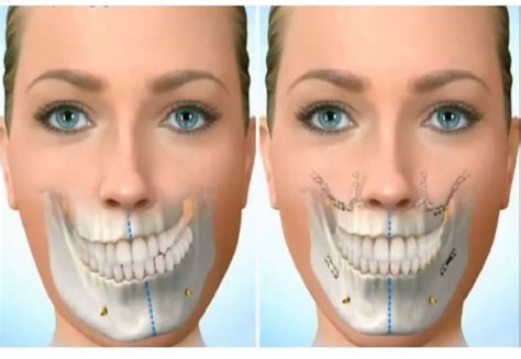 ¿qué procedimientos realiza un cirujano oral y maxilofacial especialidades odontológicas