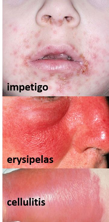 Erysipelas Vs Cellulitis Vs Impetigo