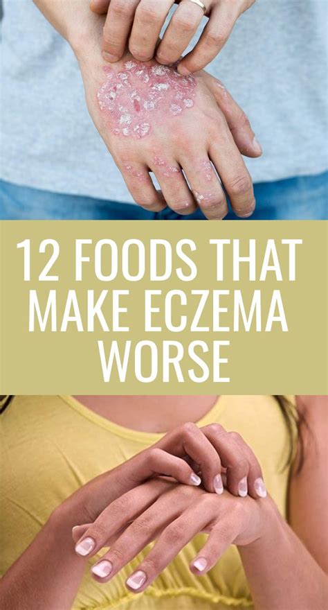 12 Foods That Make Eczema Worse Eczema Health Natural Eczema Remedies