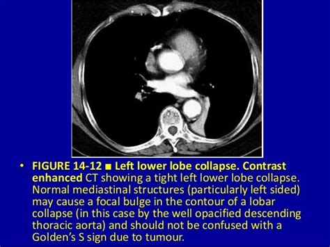 Pulmonary Lobar Collapsevessential Considerations 14 Dr Muhammad Bi