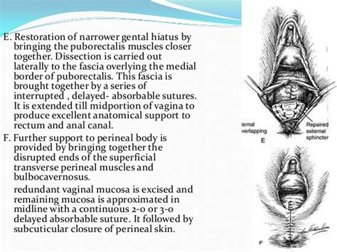 Perineal Lacerations