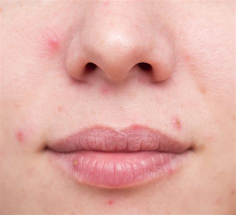 Stress Acne What It Is Its Causes And How You Can Banish It