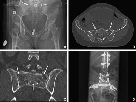 U Shaped Sacral Fractures Surgical Treatment And Quality Of Life Injury