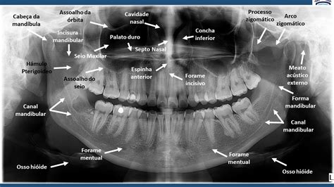 Anatomia Radiografia Panorâmica Radiologia Odontológica