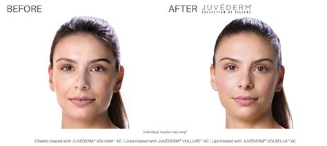 Juvéderm Before And After Real Patient Results Newport News Va