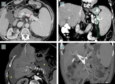 Portal Hypertension Imaging Findings On Mdct A Portal Venous Phase