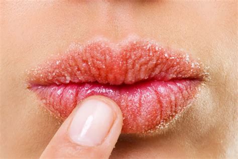 Allergic Reactions On The Lips Causes And Treatments Lifemd