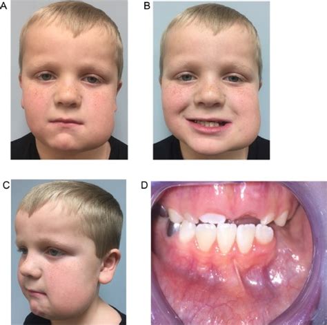Early Detection Of Cherubism With Eventual Bilateral Progression A Literature Review And Case