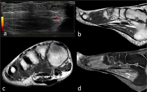 Plantar Fibromatosis Ultrasound Of The Right Foot Shows Avascular