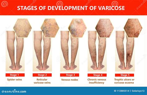 Varicose Veins On A Female Senior Leg Stock Photo Image Of Concept