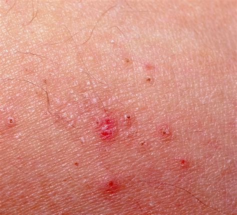 The Best Scabies Treatment Healthy Living