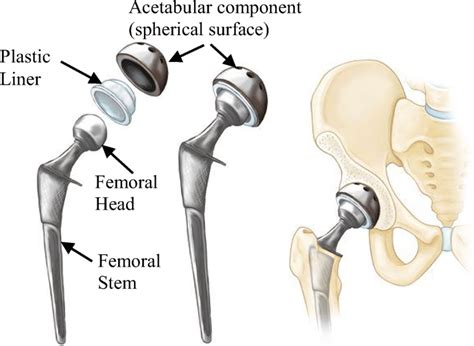 types of total hip replacement doctorvisit