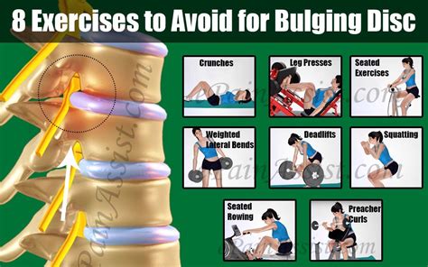 8 Exercises To Avoid For Bulging Disc Bulging Disc Exercise Bulging