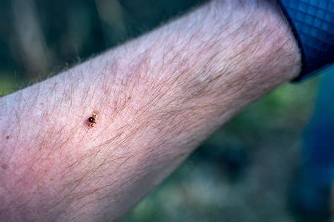 The Bizarre Link Between Lone Star Tick Bites And Red Meat Allergies