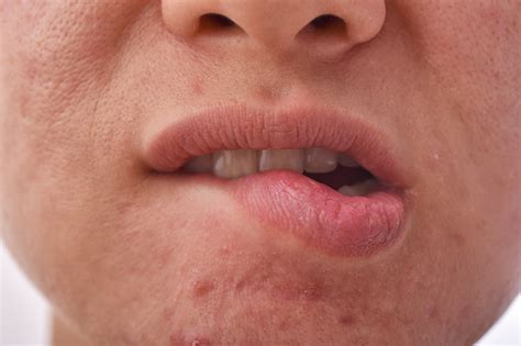 Skin Disease Problem Dry And Chapped Lip From Lip Biting Acne Scar And