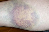 Bruise on the leg - Stock Image - C016/9306 - Science Photo Library