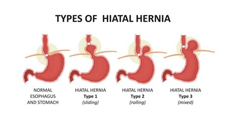 Hiatal Hernia Types Symptoms Causes Diagnosis Treatment And More