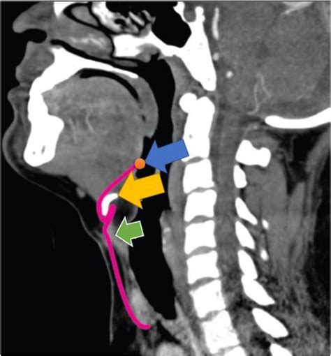 Sagittal Section Cervical Computed Tomography Ct Showing The