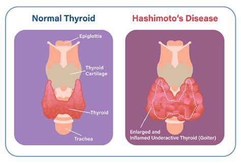 Hashimotos Thyroiditis American Thyroid Association