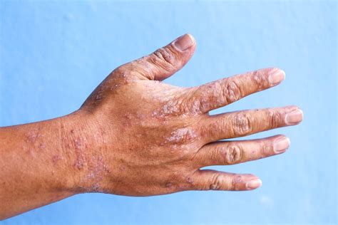 Robe Fleurie Mariage 39 Psoriasis On Hands Vs Eczema