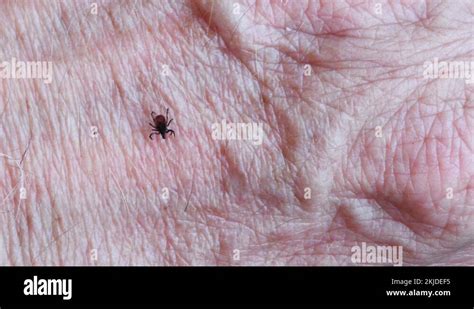 Tick On Human Skin Parasite Stock Video Footage Alamy