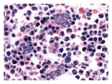 Distinct Histologic Features Of Macrophages Containing Other Cell