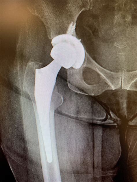 Case Study Revision Isolated Hip Replacement In 64 Year