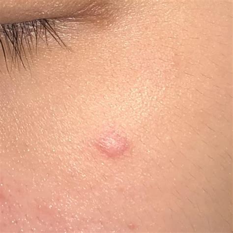 Had This Bump On My Face For Years Now Dermatologist Says Its Benign Thinking Of Getting It