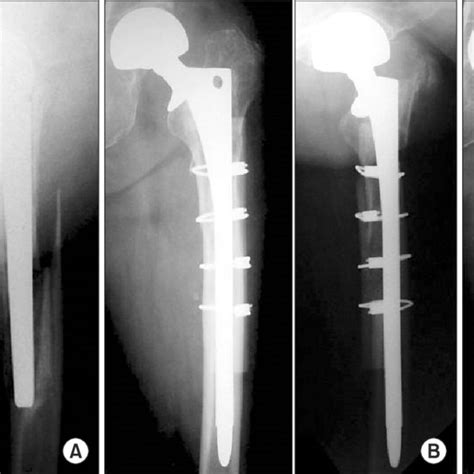 Pdf Femoral Stem Revision For Vancouver Type B2 And B3 Periprosthetic