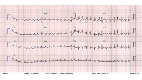 Case Infective Endocarditis