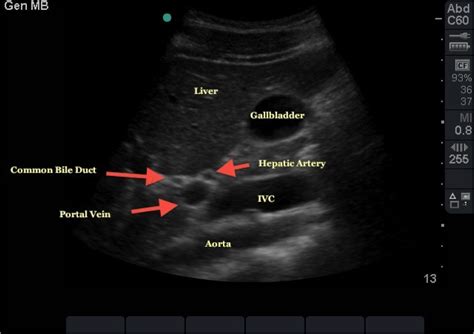 Sonography Liver Anatomy Chapter 14 Diagram Quizlet