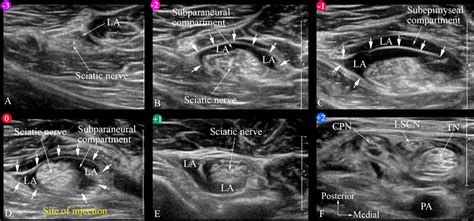 Ultrasound Guided Subparaneural Popliteal Sciatic Nerve Block There Is