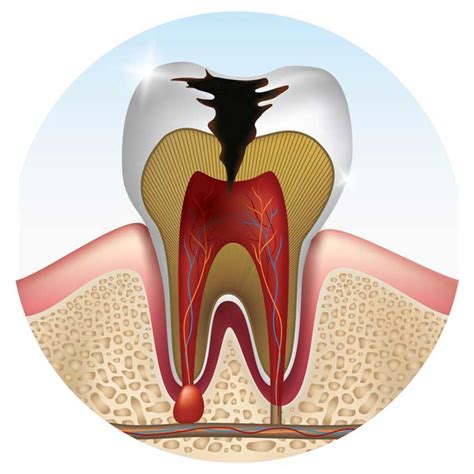 Wisdom Tooth Cavity Symptoms And Treatment Options