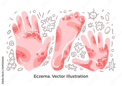 Vector Set Eczema Illness Symptom Bacteria Skin Rashes On Arm Hand